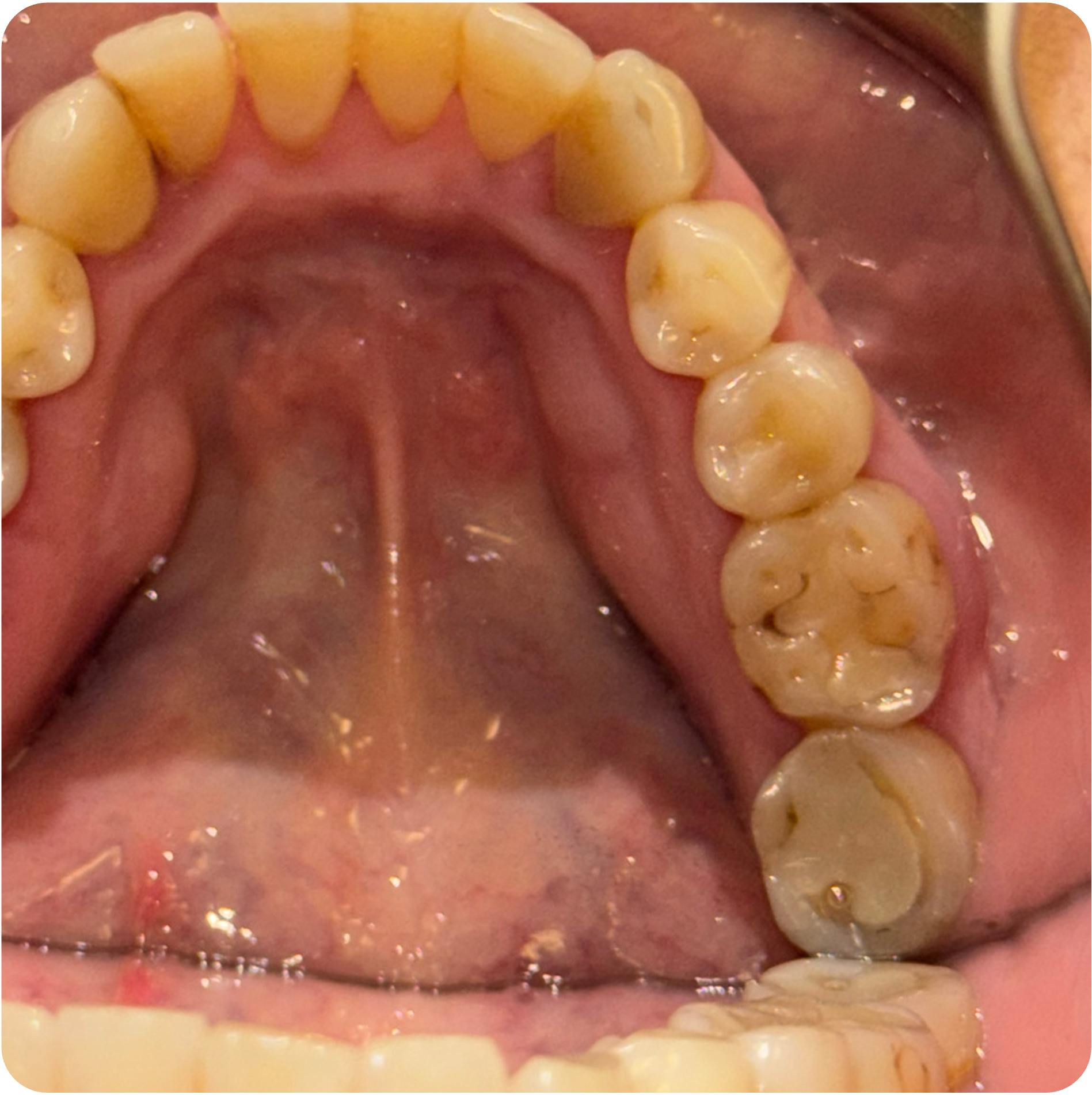 Periodontal scaling and root planing visit on September 18, 2025