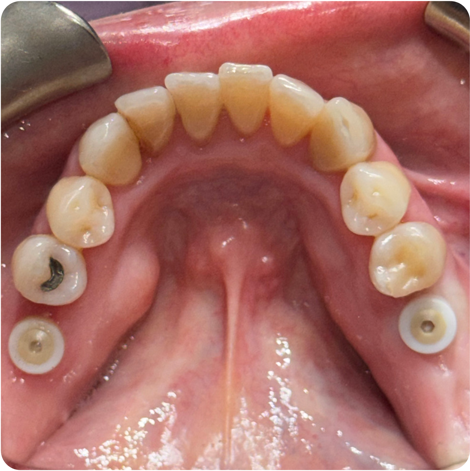 Follow-up and questionnaire version 2 visit on January 14, 2026