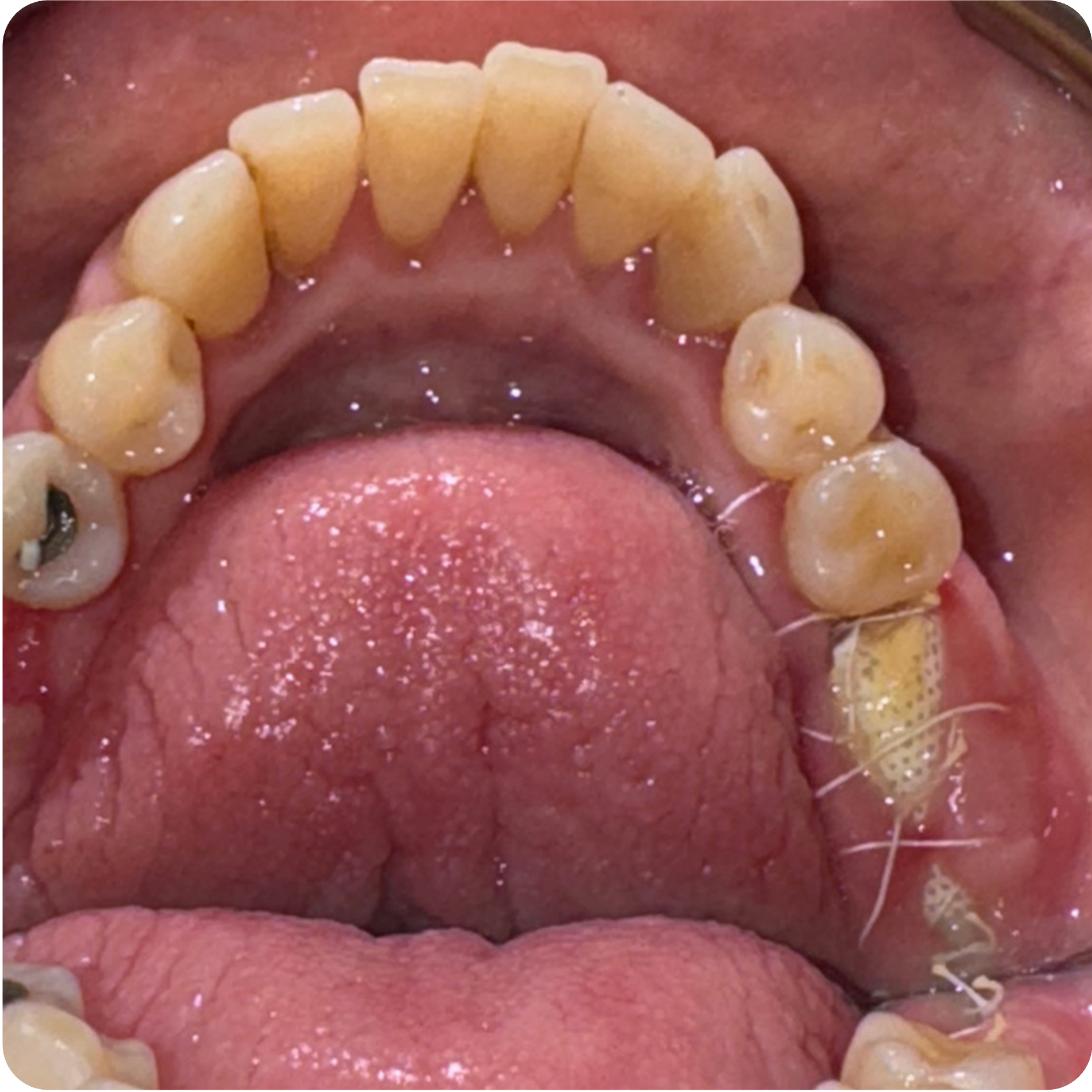 Implant placement at sites 14 and 19 on December 2, 2025