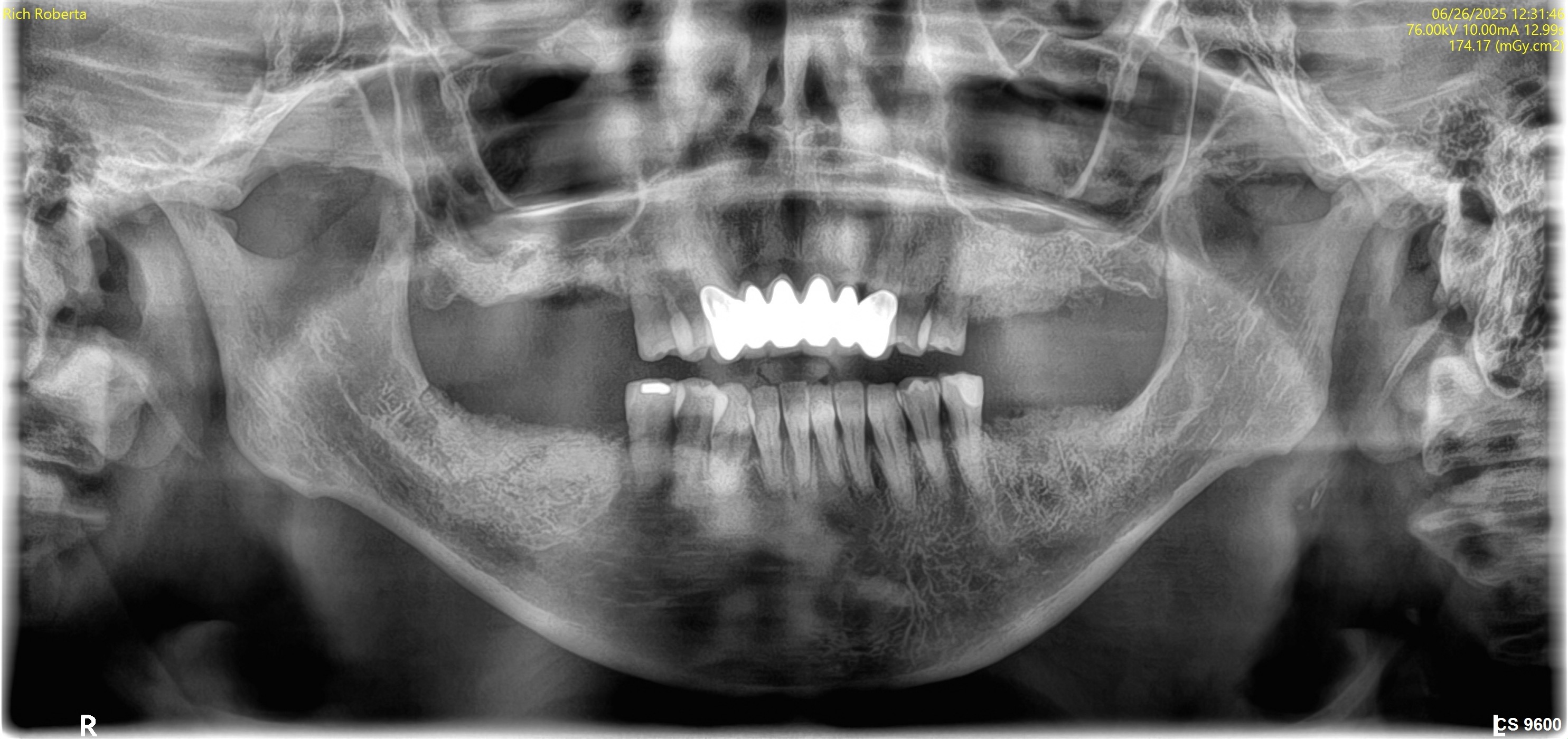 Before treatment photo for Roberta R full-mouth case
