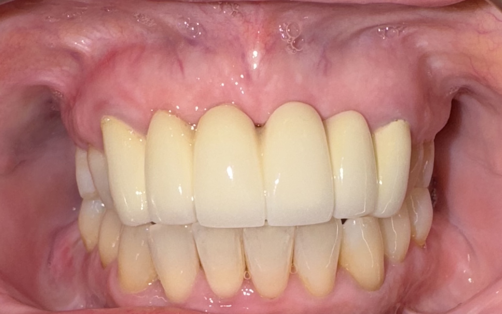 CBCT and clinical overview of Roberta R biological full-mouth treatment case at Groton Wellness