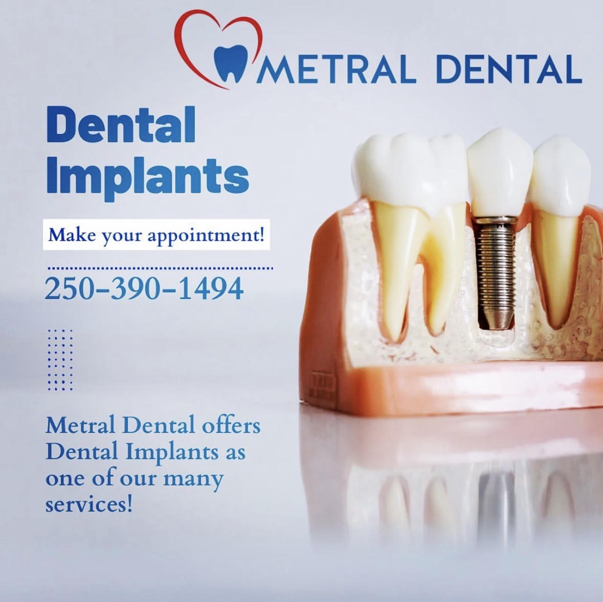 Dental Implants in Nanaimo | Are Dental Implants Worth it? | Metral Dental