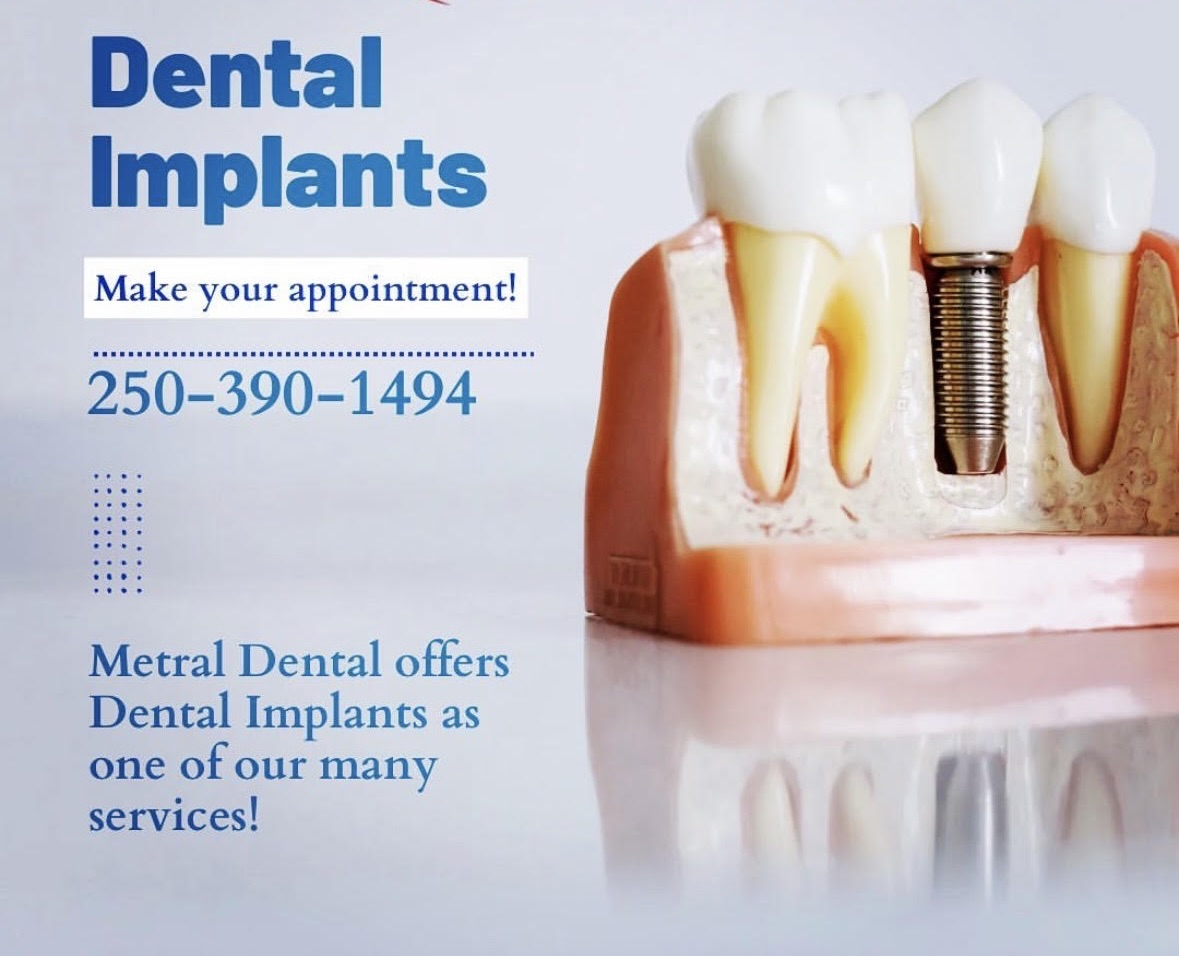 Dental Implants in Nanaimo