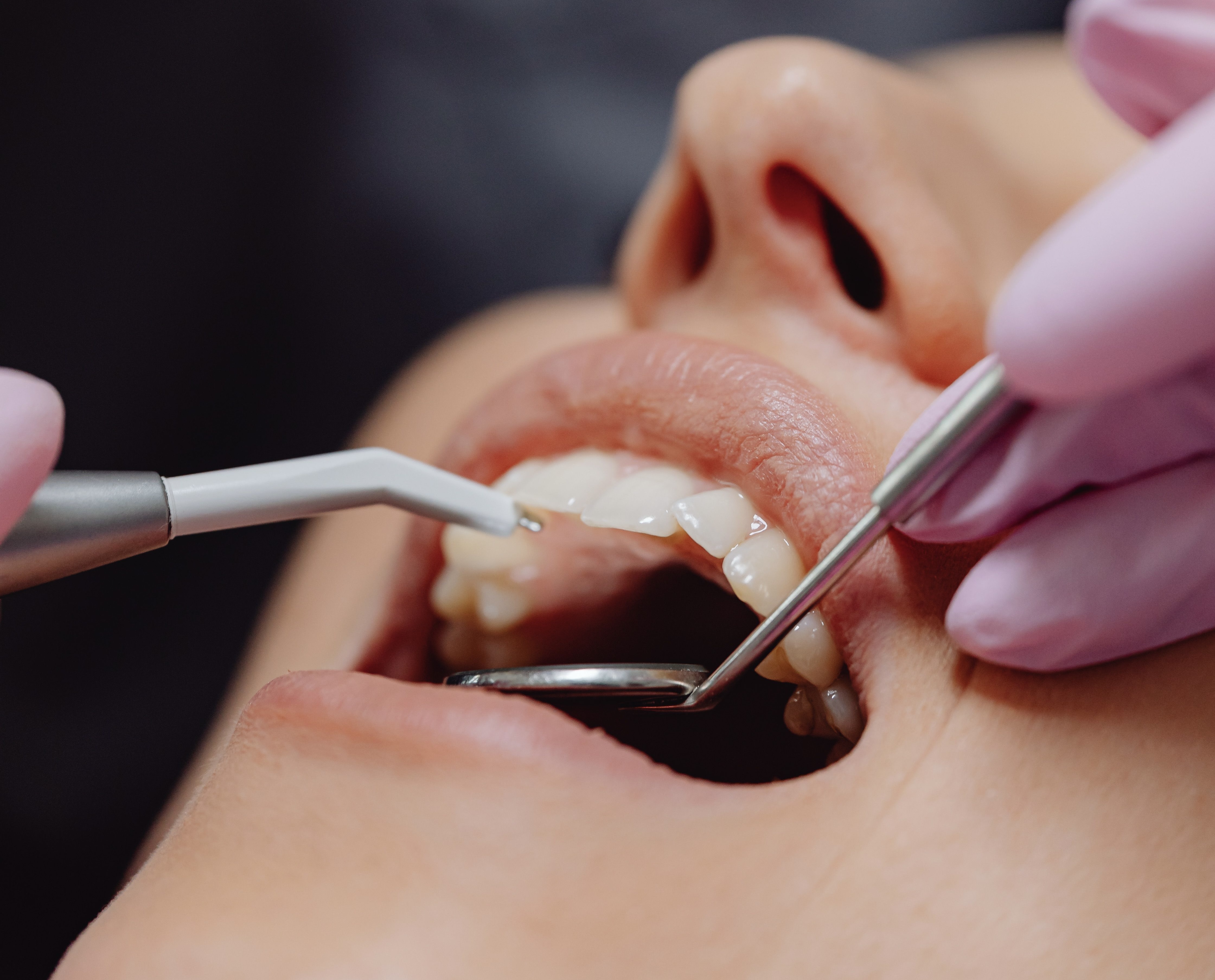 Dental Fillings: When You Need One, What to Expect, and How to Make It Last