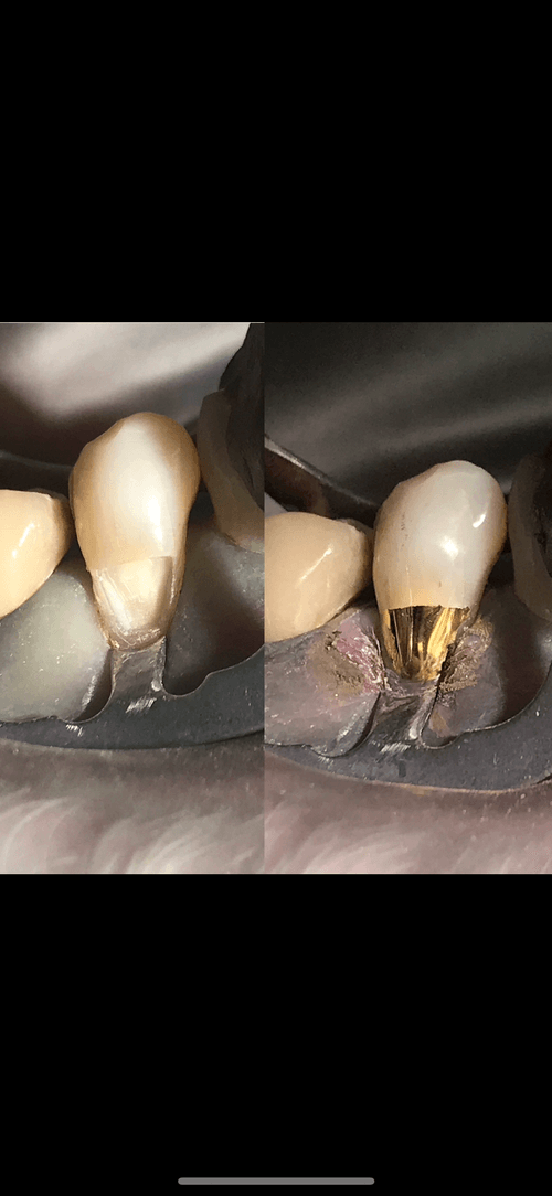 Artistic Dentistry & Gold Foil Restorations
