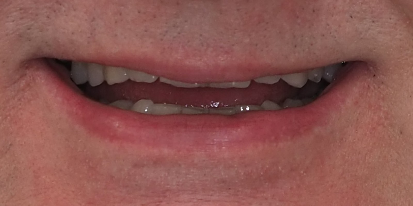 Uśmiech pacjenta przed leczeniem – metamorfoza Hollywood Smile
