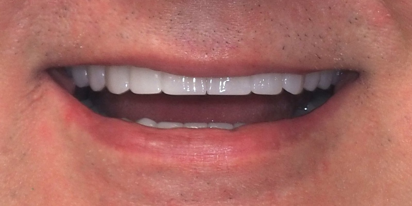 Uśmiech pacjenta po leczeniu – metamorfoza Hollywood Smile
