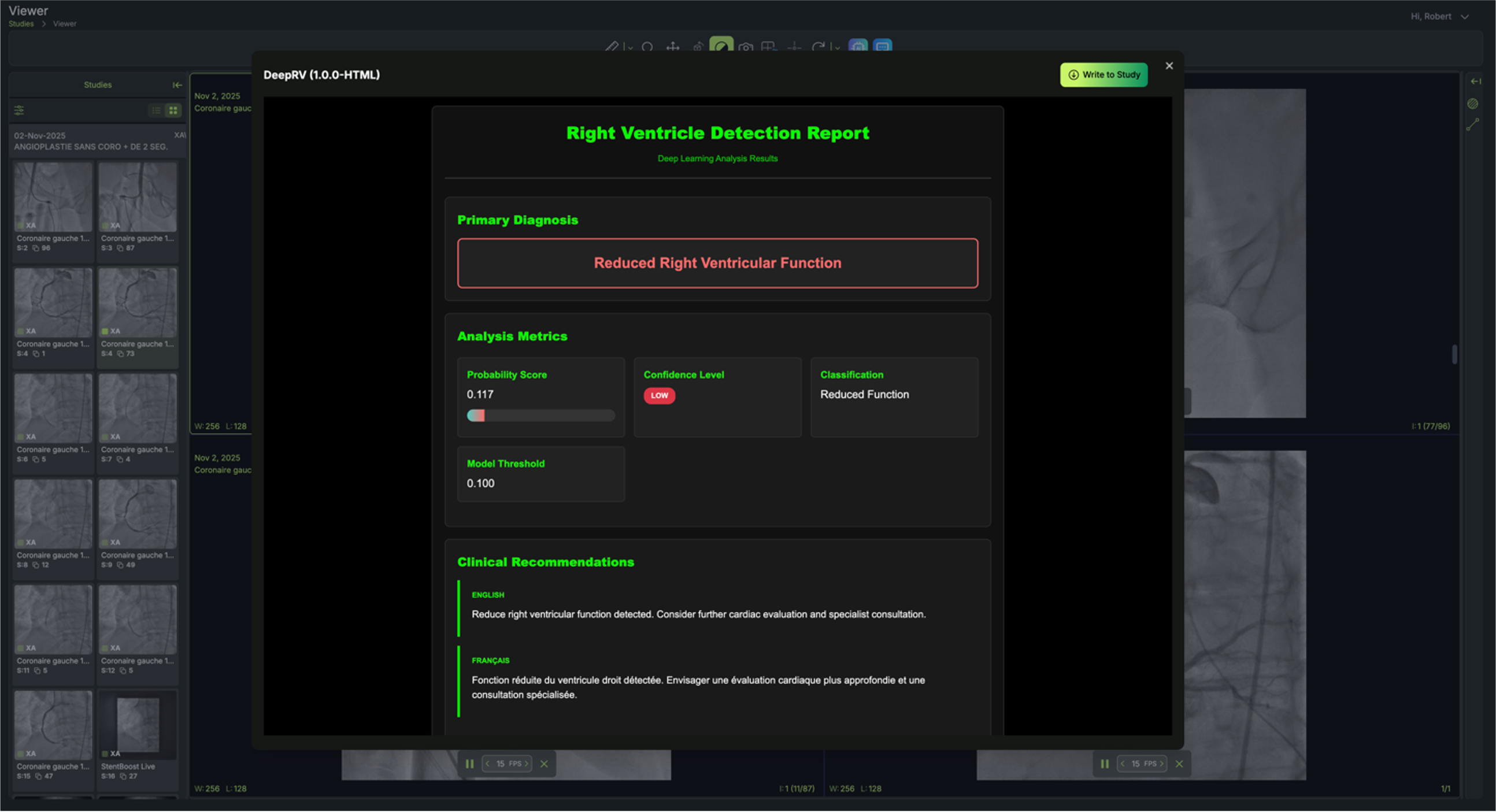 DeepRV RV detection report in PACS-AI