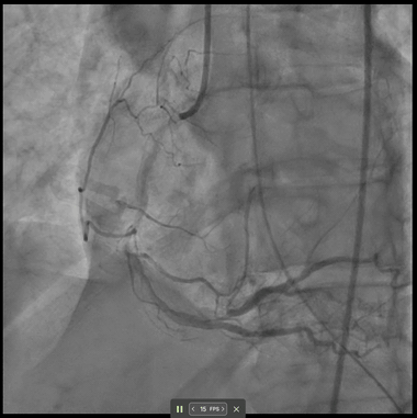 Pre-PCI angiogram of confirmed reduced RVSF case