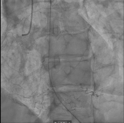 Pre-PCI diagnostic angiogram