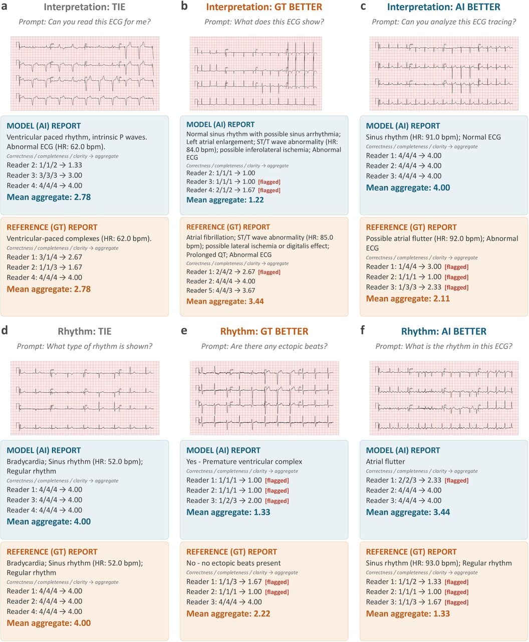 Comptes rendus représentatifs de DeepECG-Tok et évaluations des cardiologues