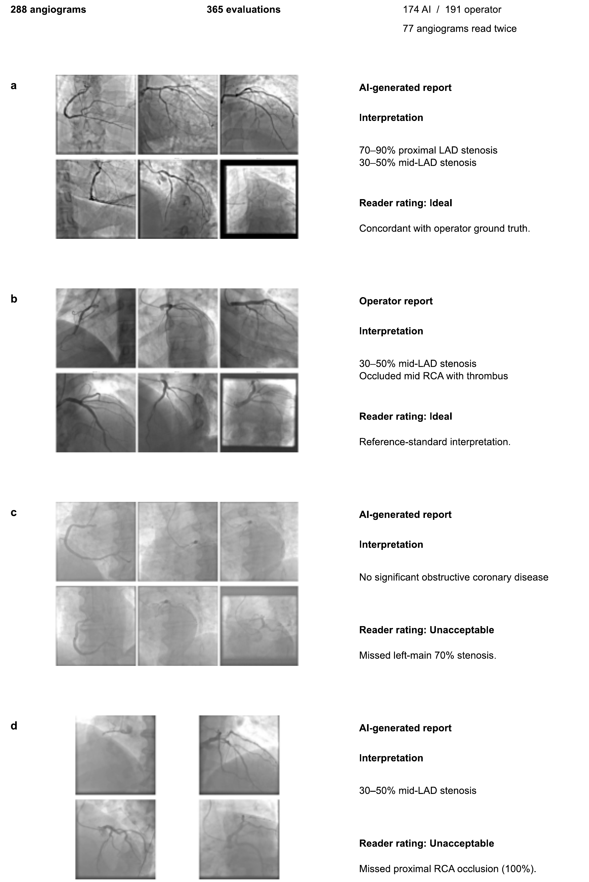 Original model and operator reports with blinded cardiologist verdicts, including missed proximal stenoses.