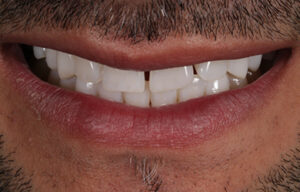 Before