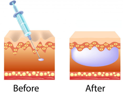 Hair Transplant