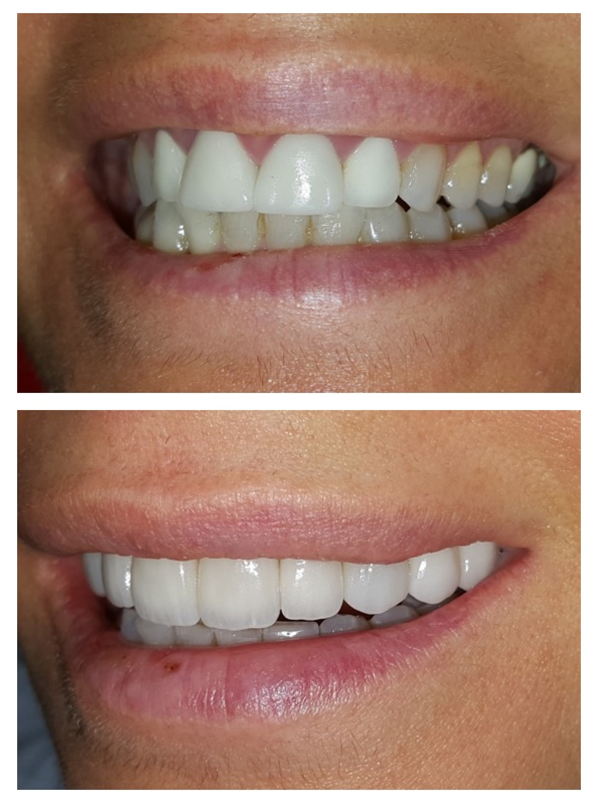 smile makeover before and after