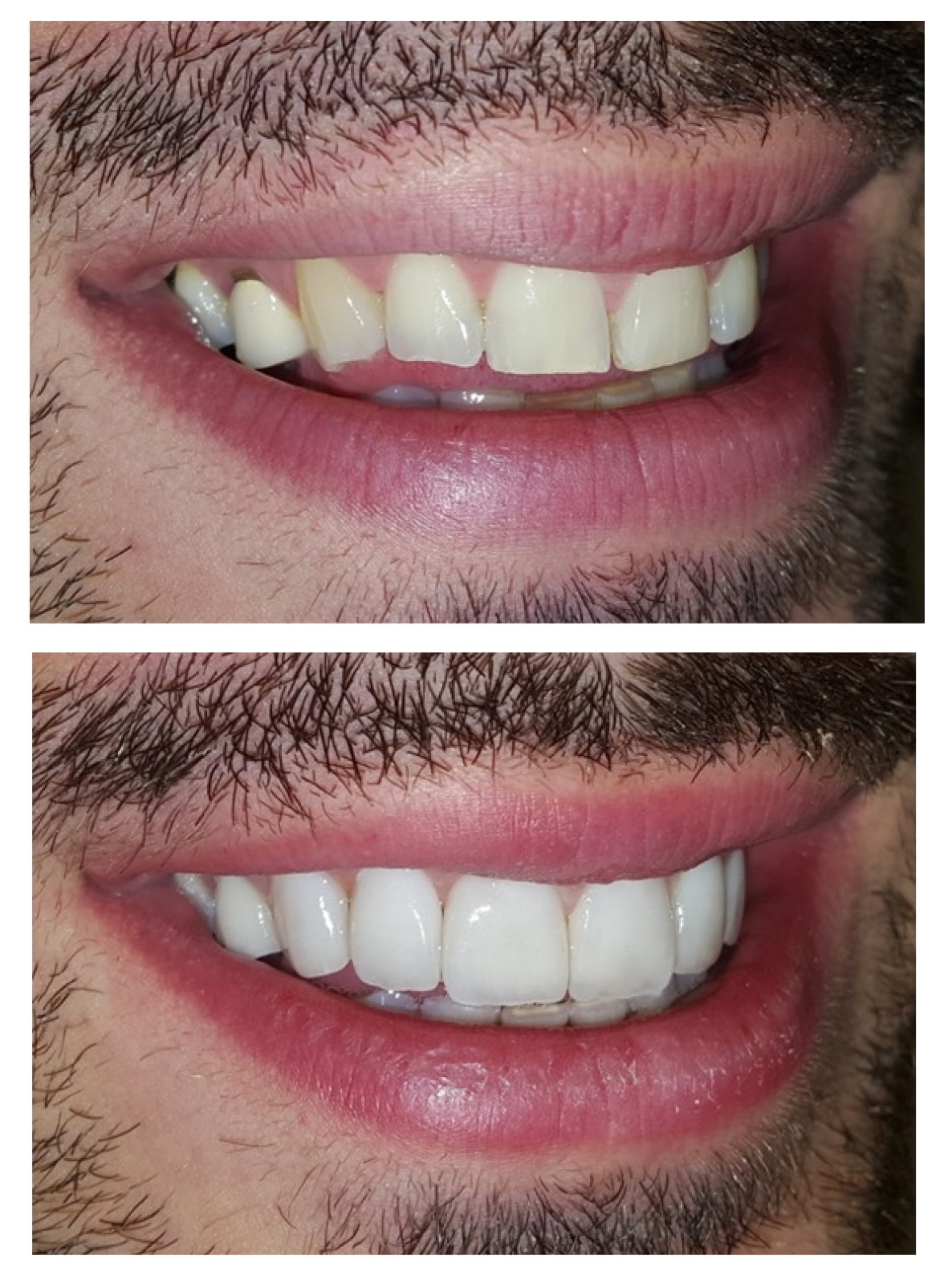 Composite veneers Turkey before and after