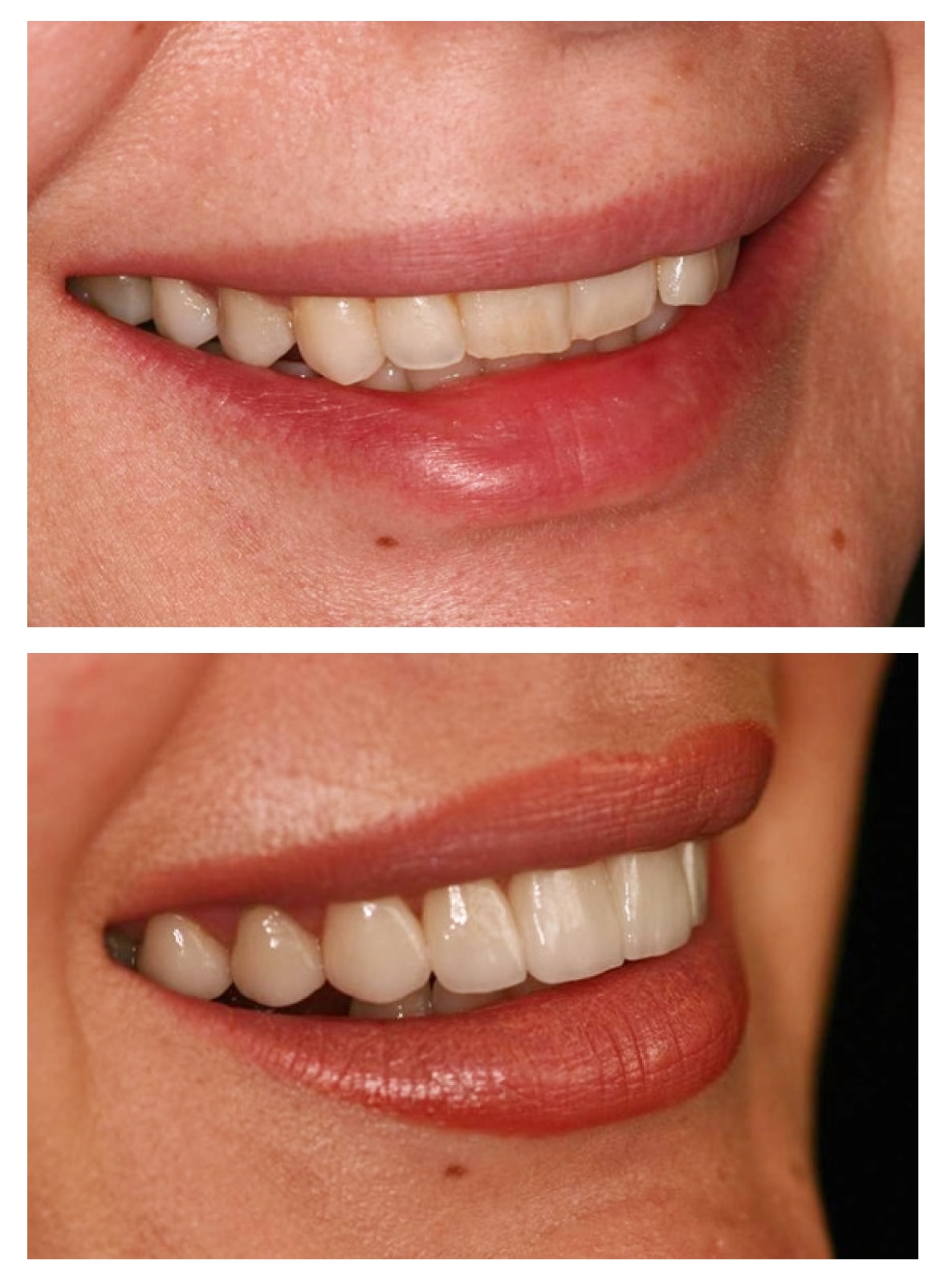 Smile makeover