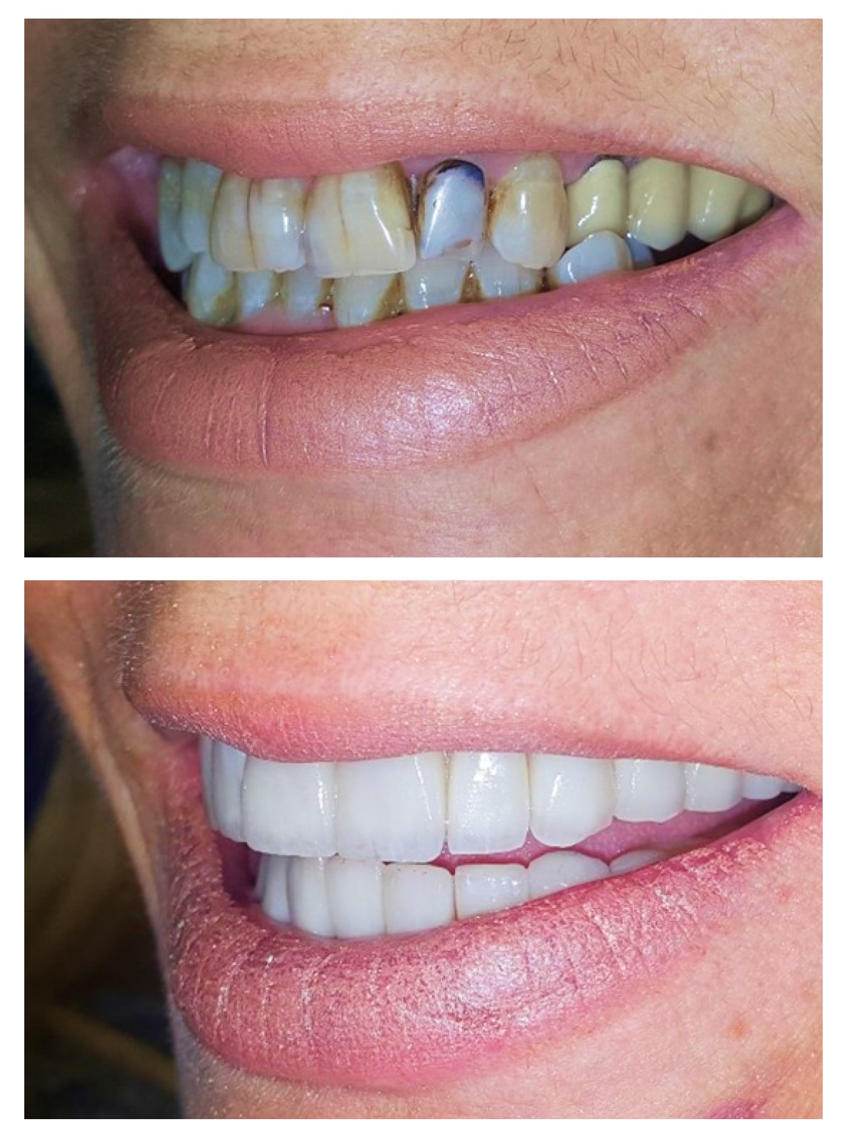 Porcelain Veneers Before and after