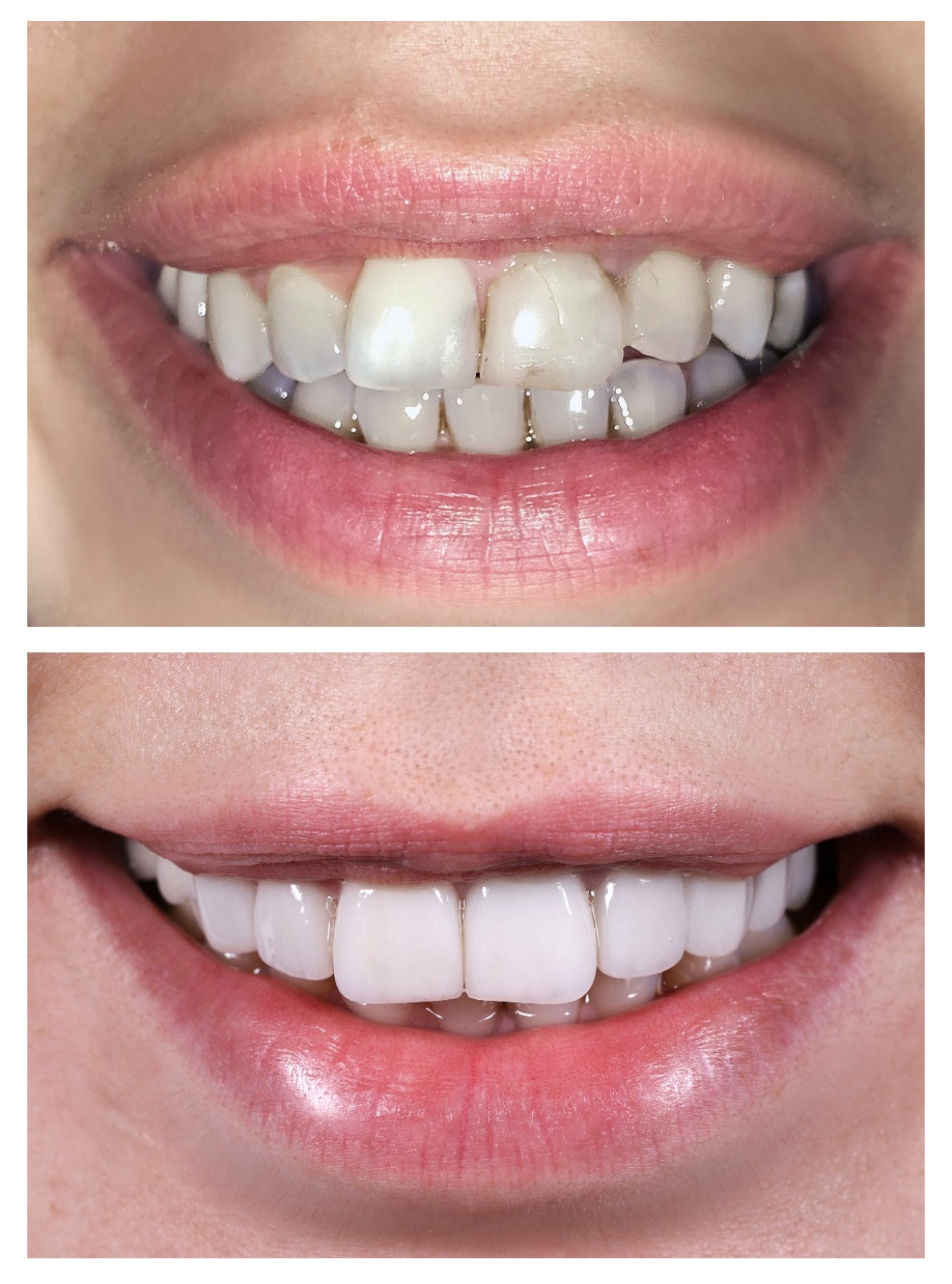 Veneers 