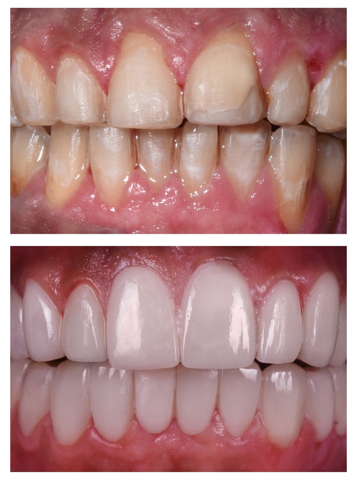 Veneers prices 