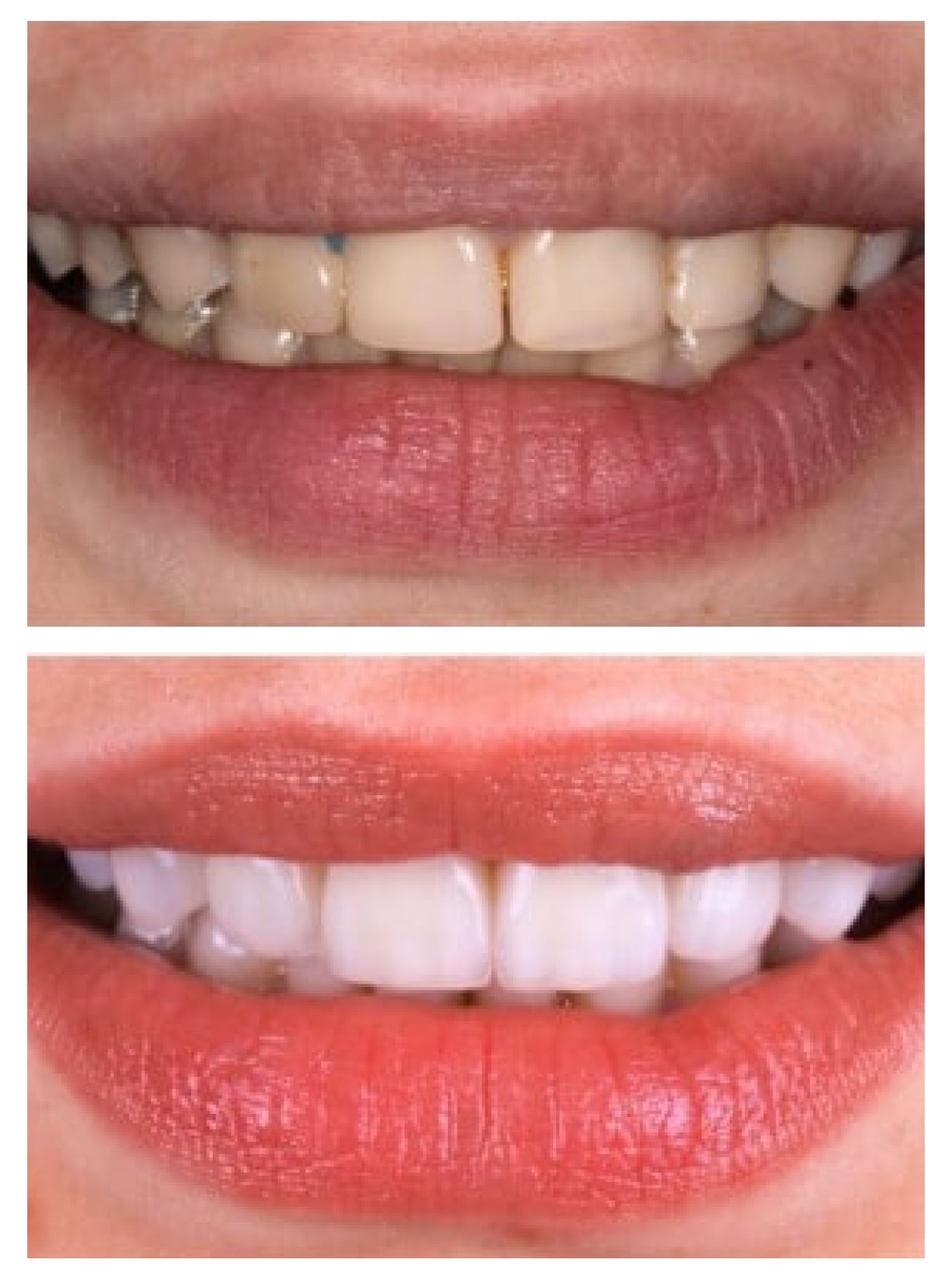 Veneers prices in Turkey