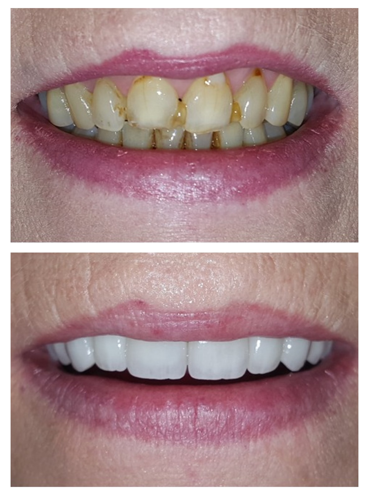 Composite veneers before and after