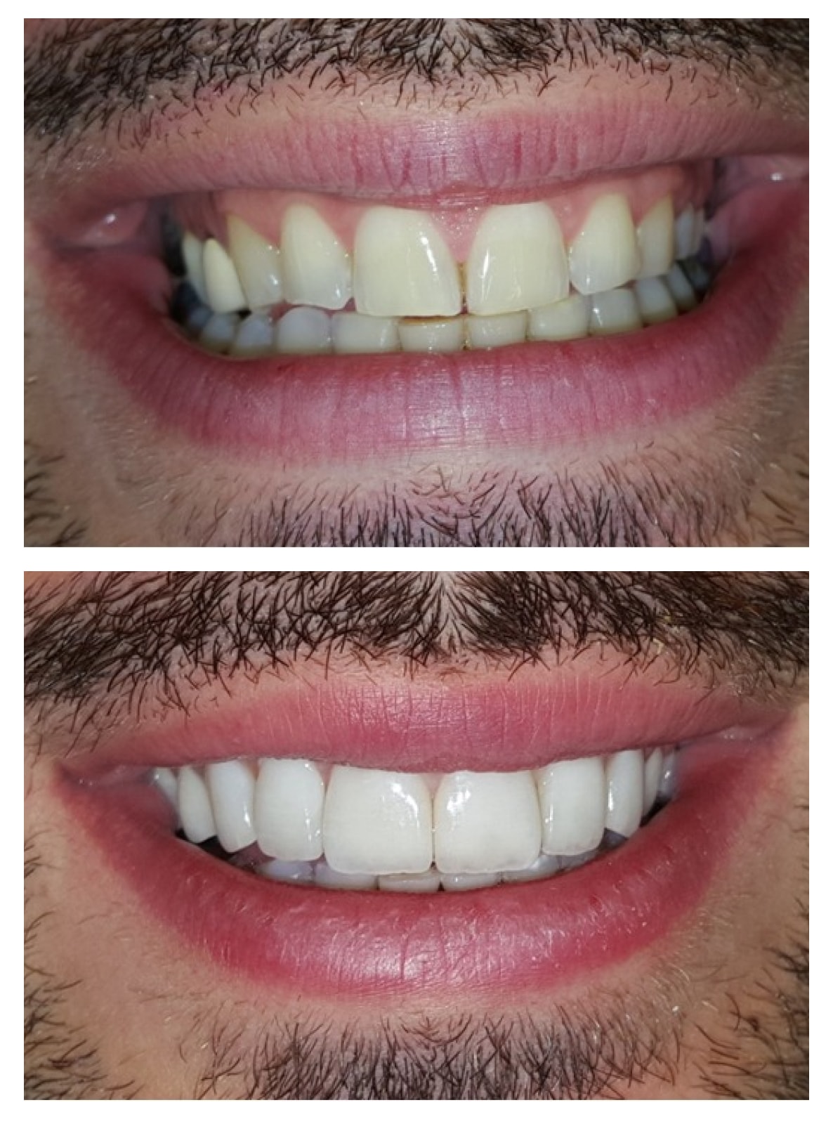 Veneers  before and after
