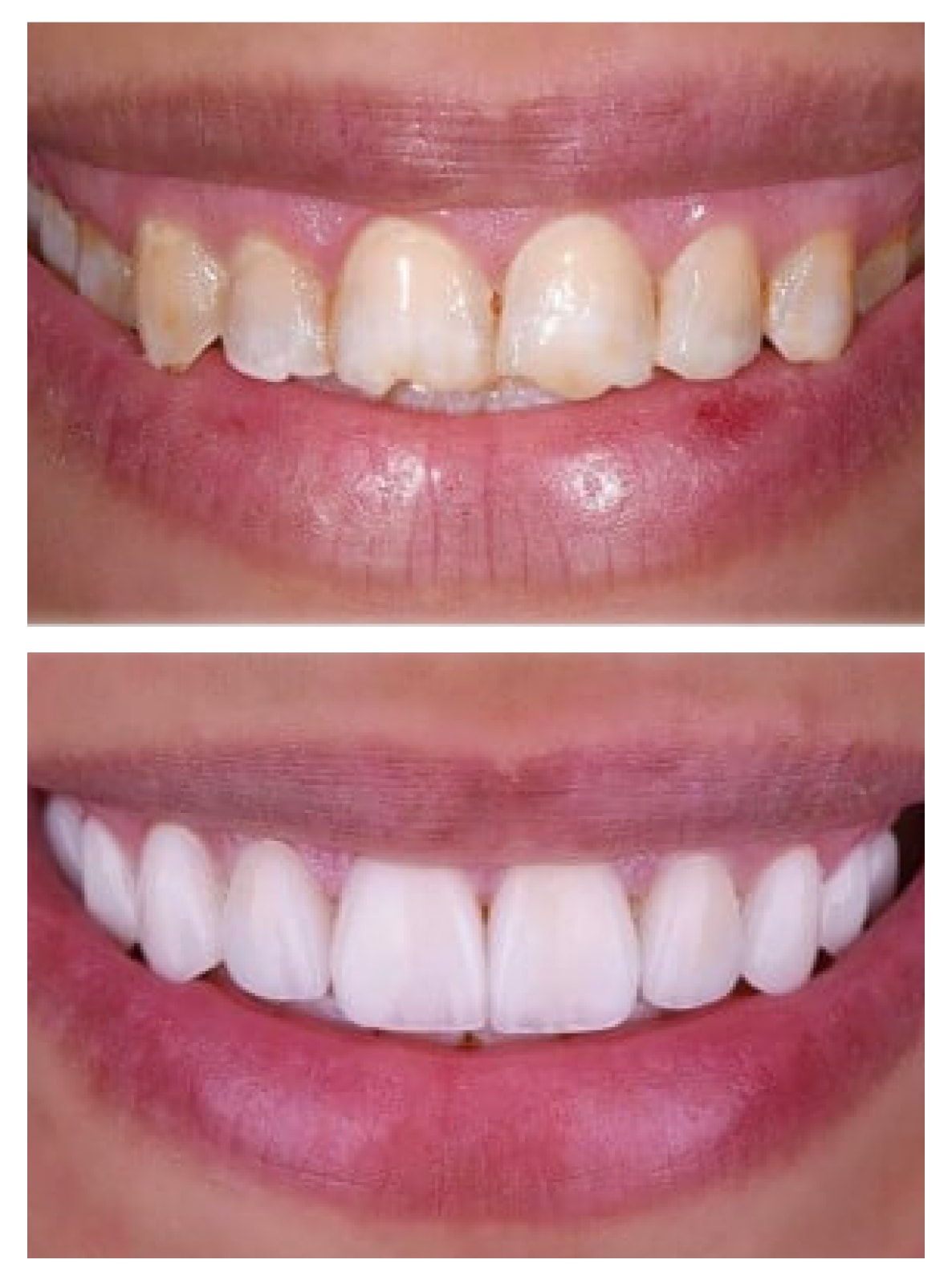 Porcelain veneers Turkey before and after
