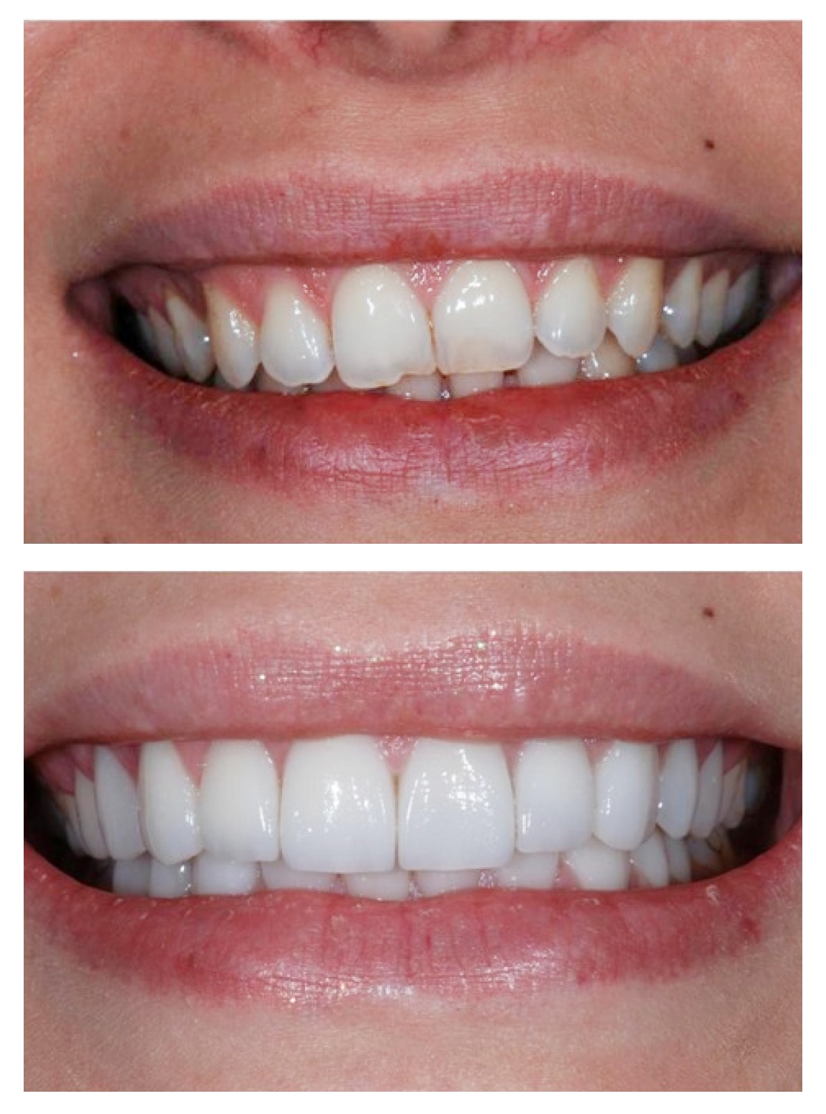 Composite veneers Turkey