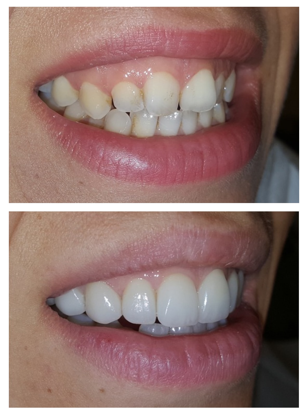 Veneers before and after