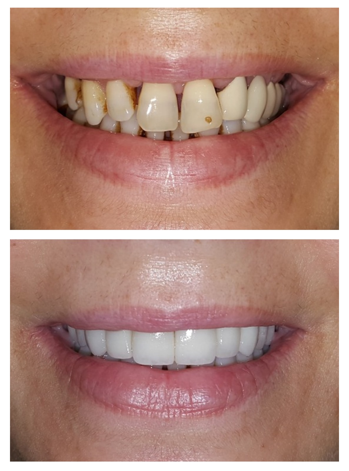 Porcelain Veneers Turkey