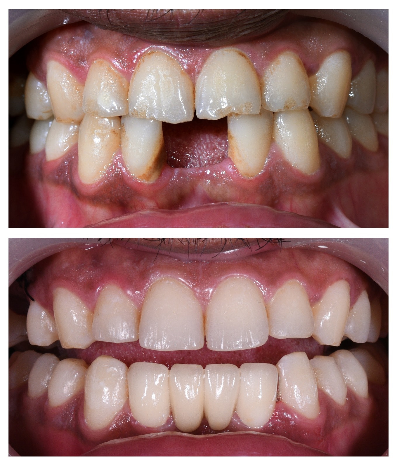 Dental implant Turkey before and after
