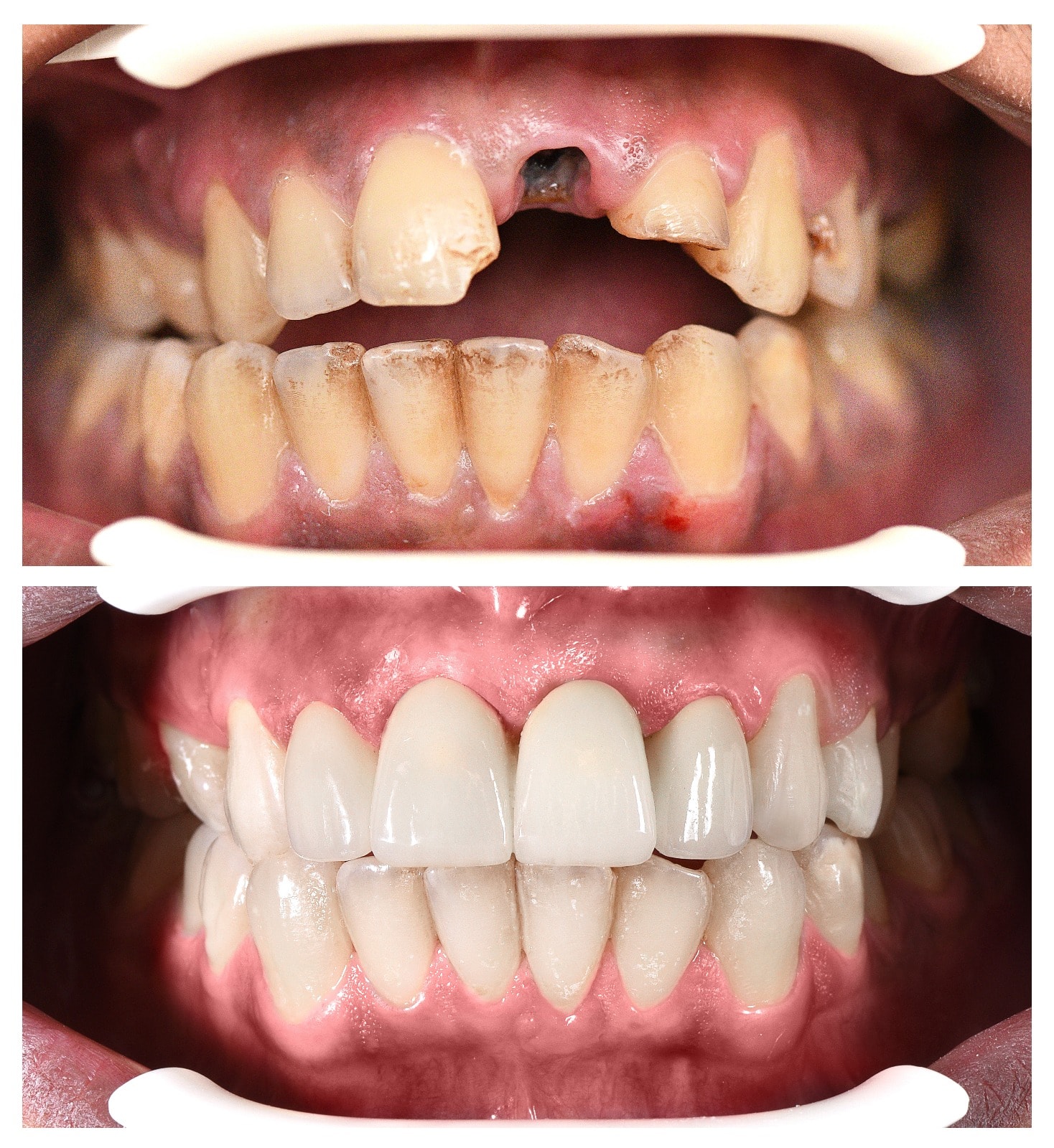 Dental implants Turkey