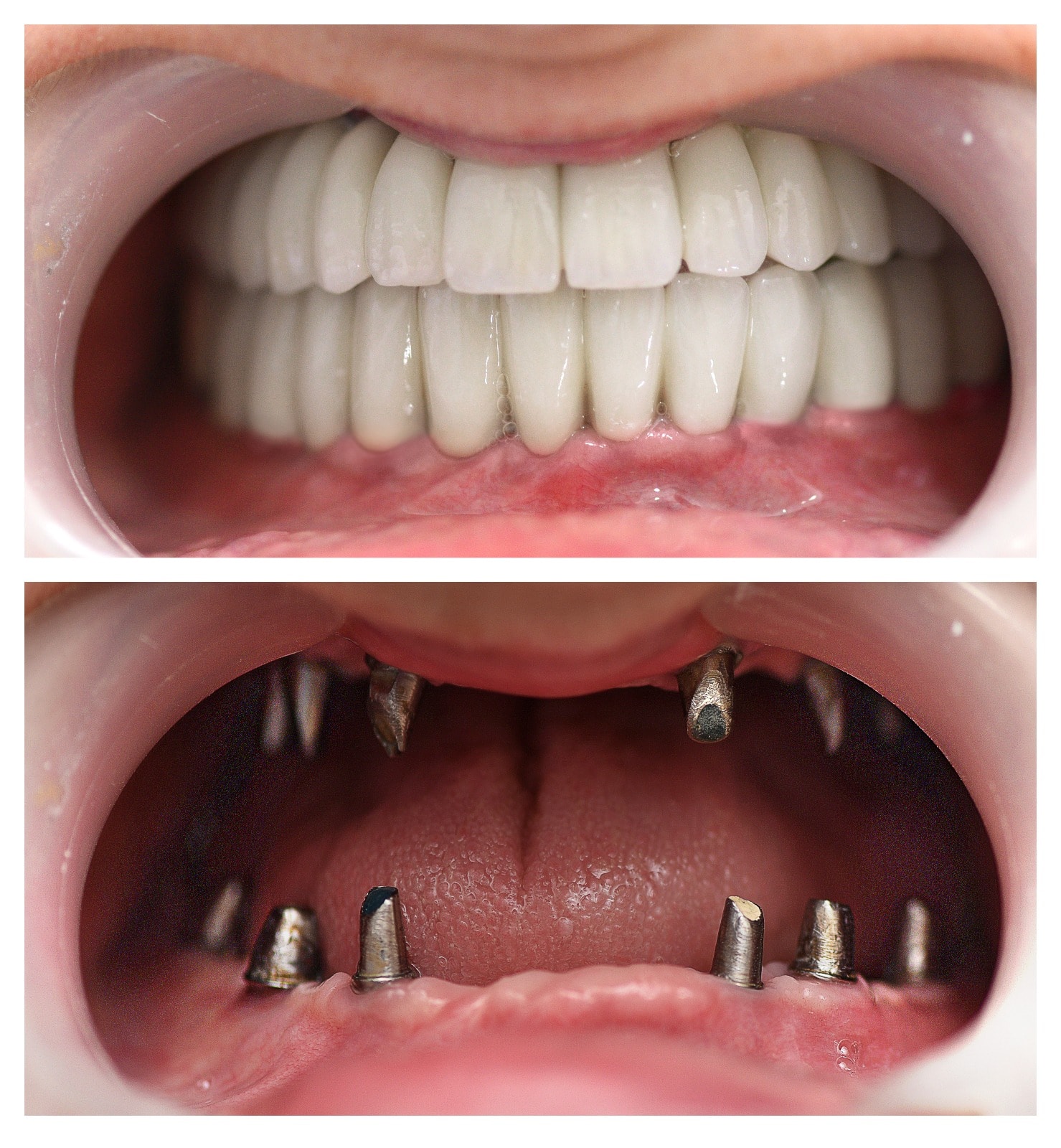 Dental implants before and after