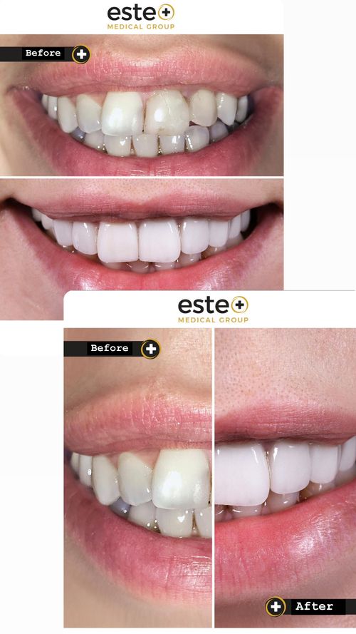 skin tightening treatment UK