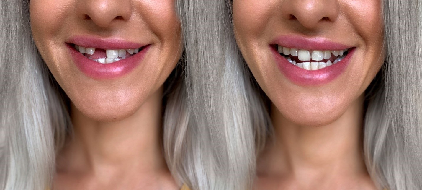 Qu’est-ce qu’une prothèse dentaire sur implant 