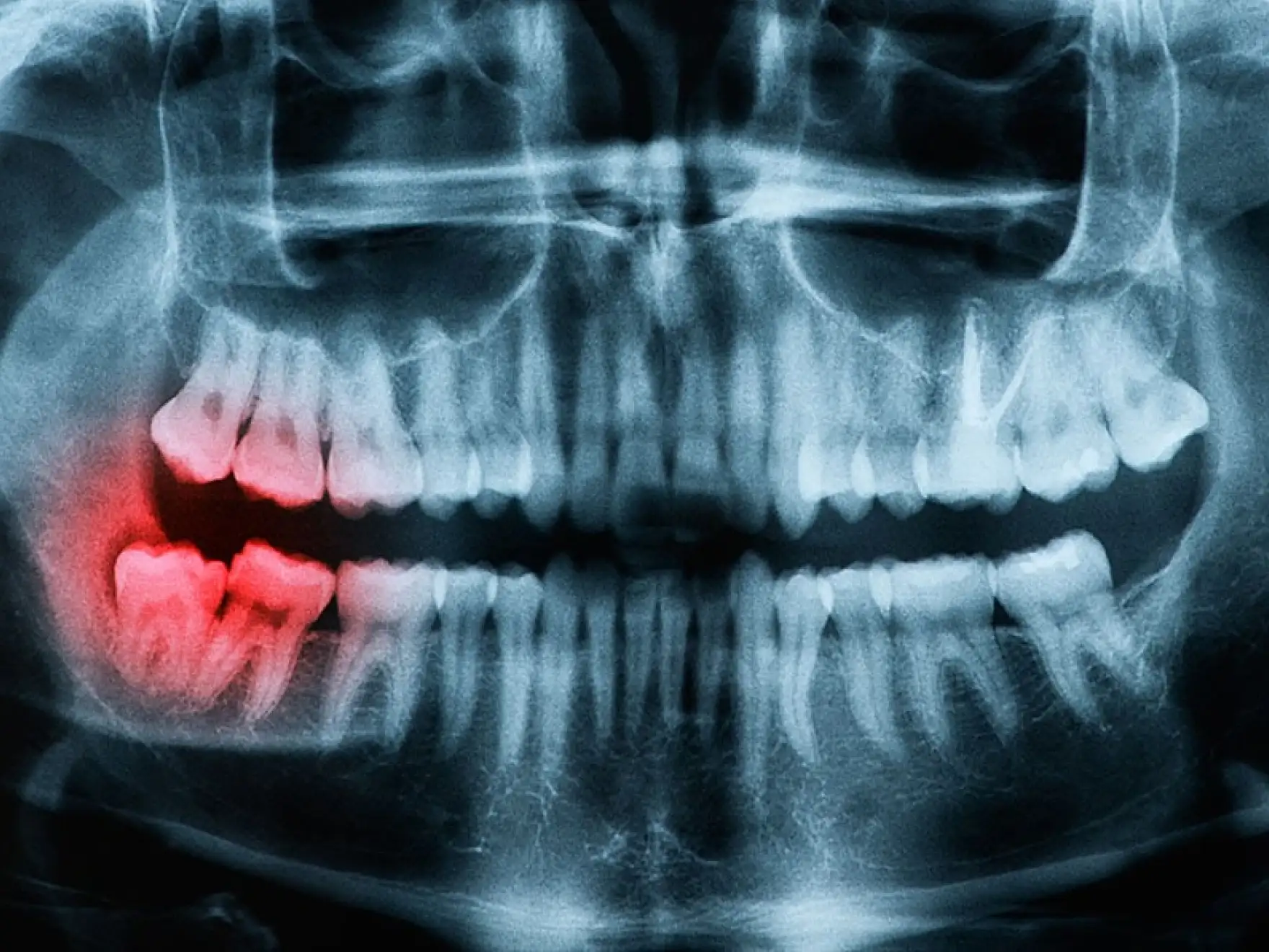 X-ray of teeth in Mount Airy, MD