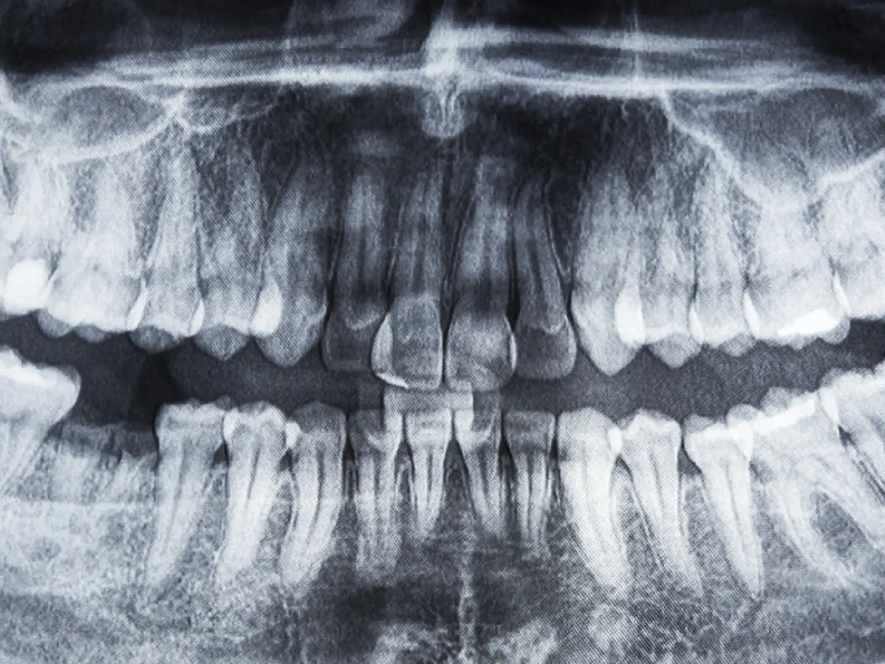 Clear Aligners in Mount Airy, MD
