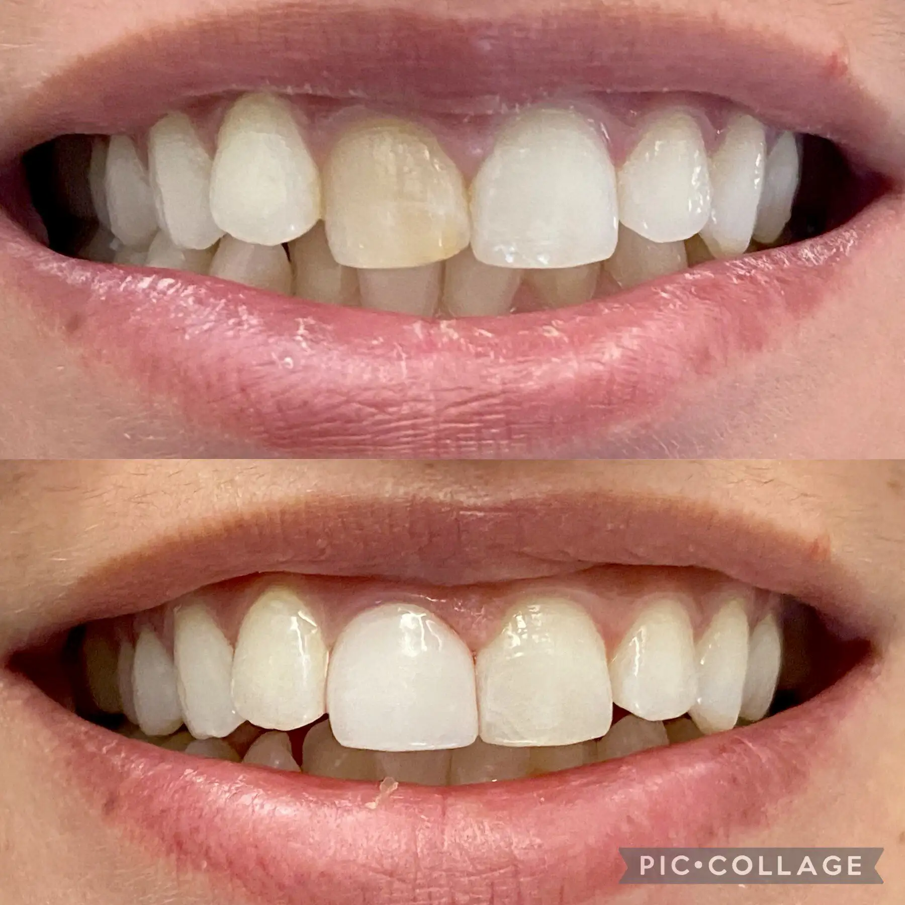 Dental Crown in Mount Airy, MD | Before and After