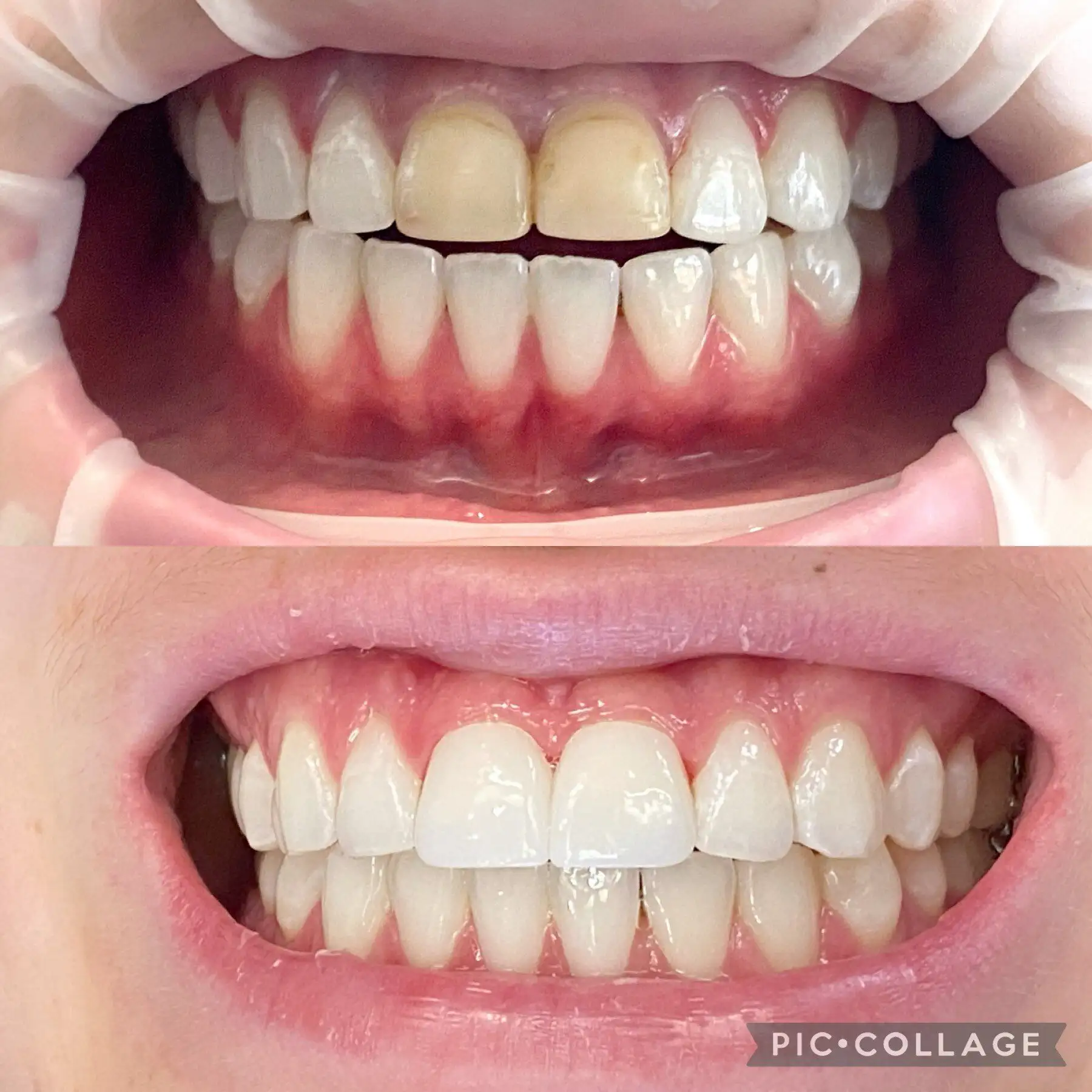 Dental Crown in Mount Airy, MD | Before and After