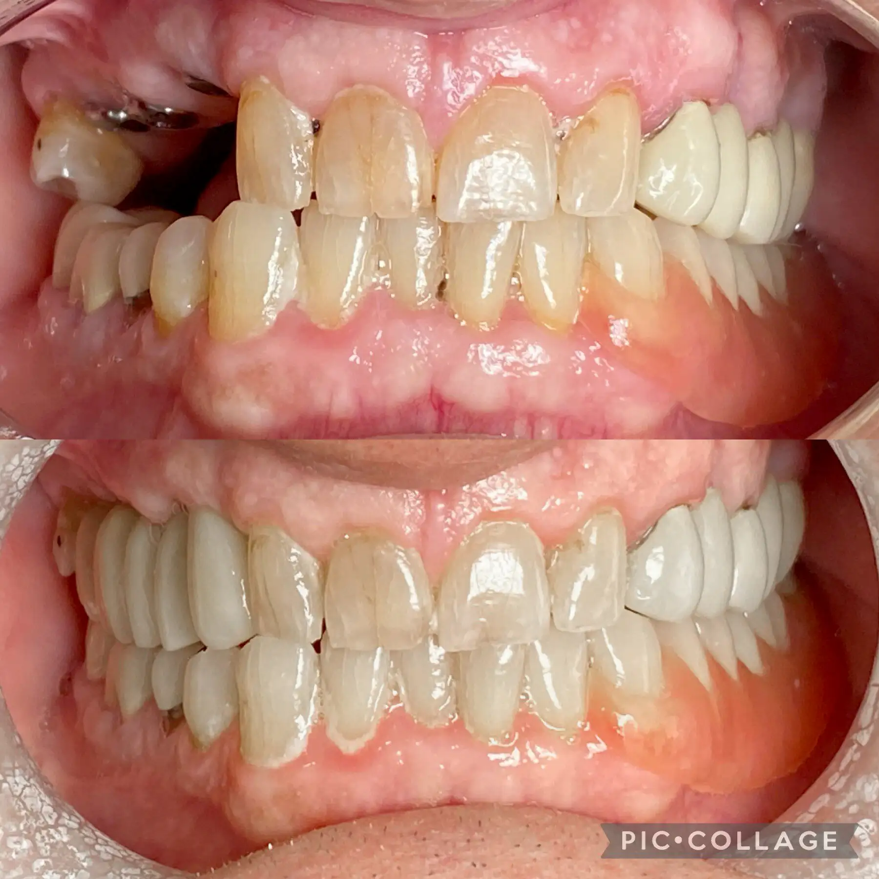 Dental Bridge and Implant in Mount Airy, MD | Before and After