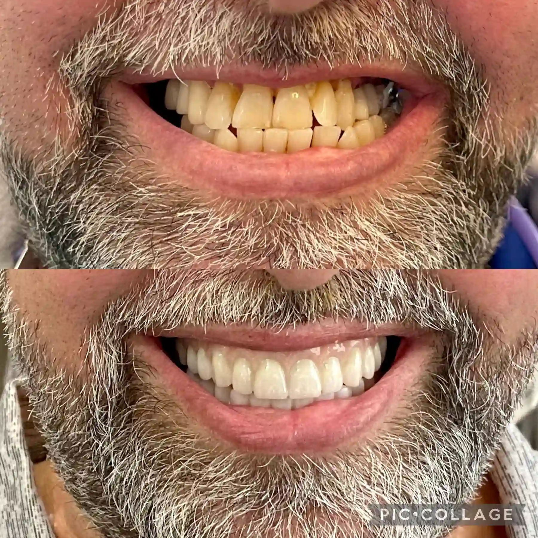 Dental Prothesys in Mount Airy, MD | Before and After