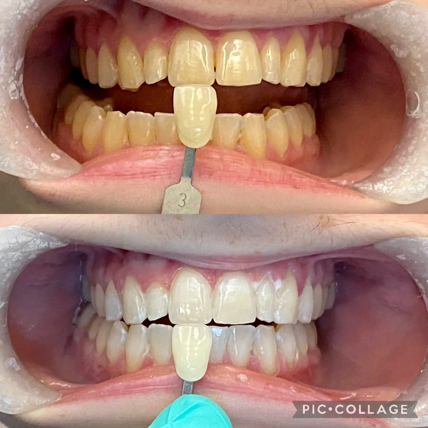 Teeth Whitening in Mount Airy, MD | Before and After