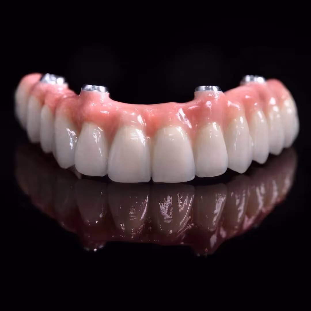 Full implant denture for the top arch.