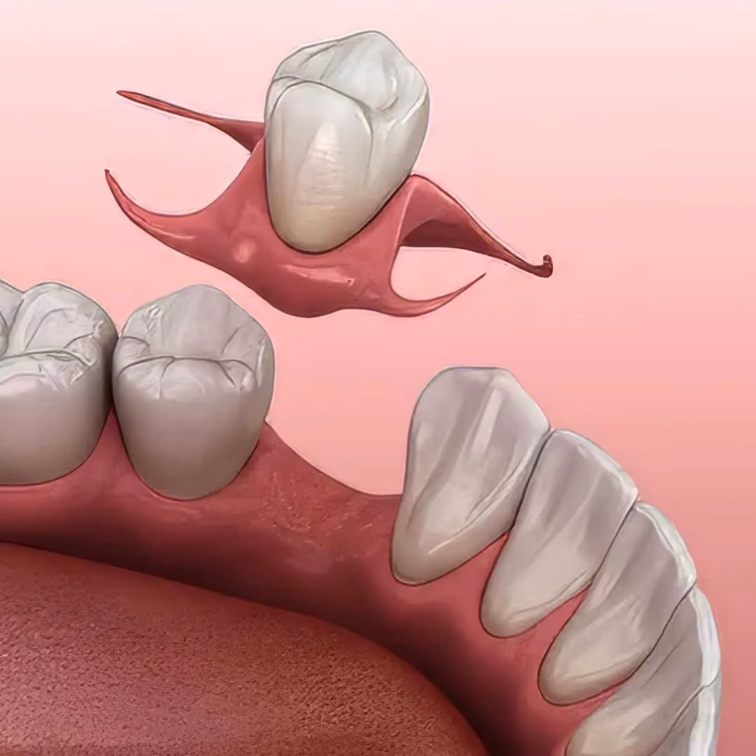 Single-tooth partial denture illustration