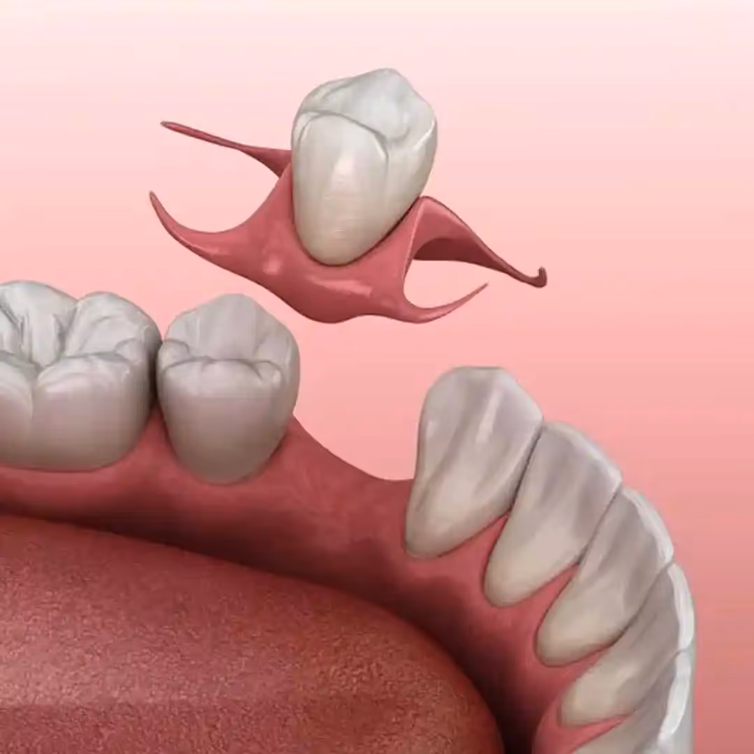 Flipper denture illustration