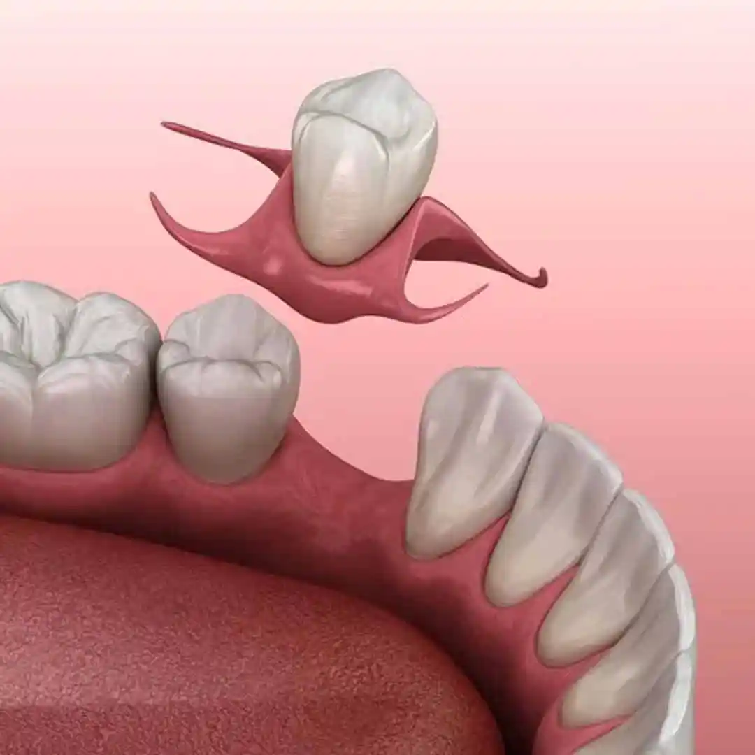 Flipper denture illustration