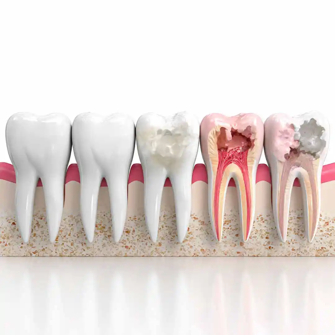 Illustration showing the different stages of tooth decay
