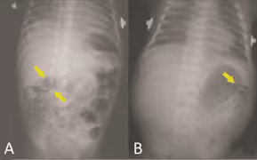 Radiografia enterocolite necrosante