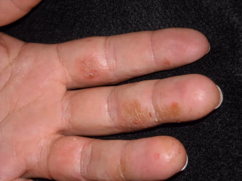 Dermatite de contato alérgica agravada pelo uso excessivo de sabões e detergentes na atividade profissional durante o inverno